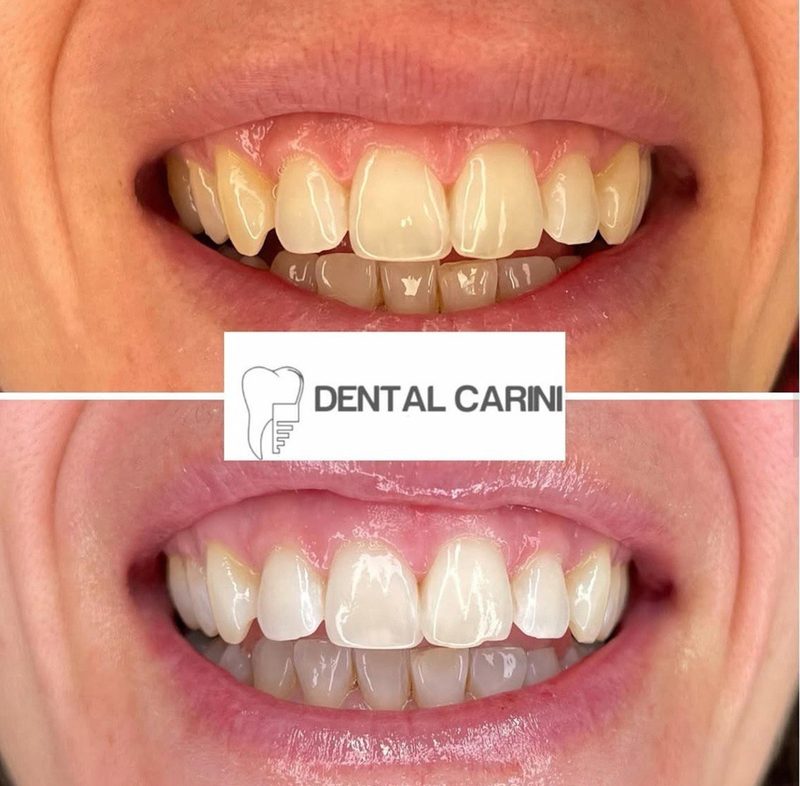 Antes y después de un blanqueamiento dental