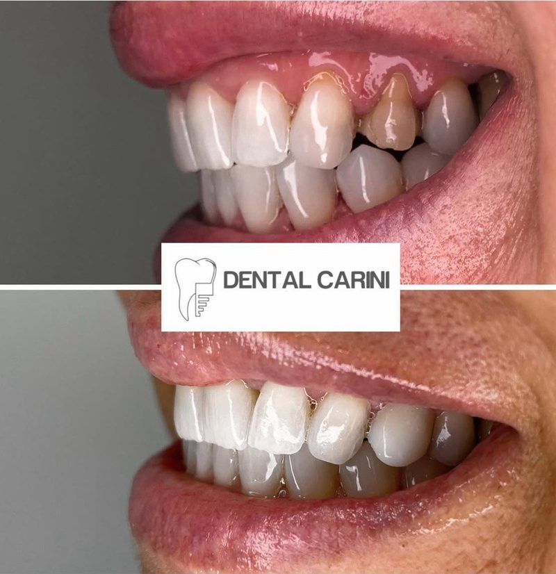 Antes y después de un tratamiento con carillas dentales